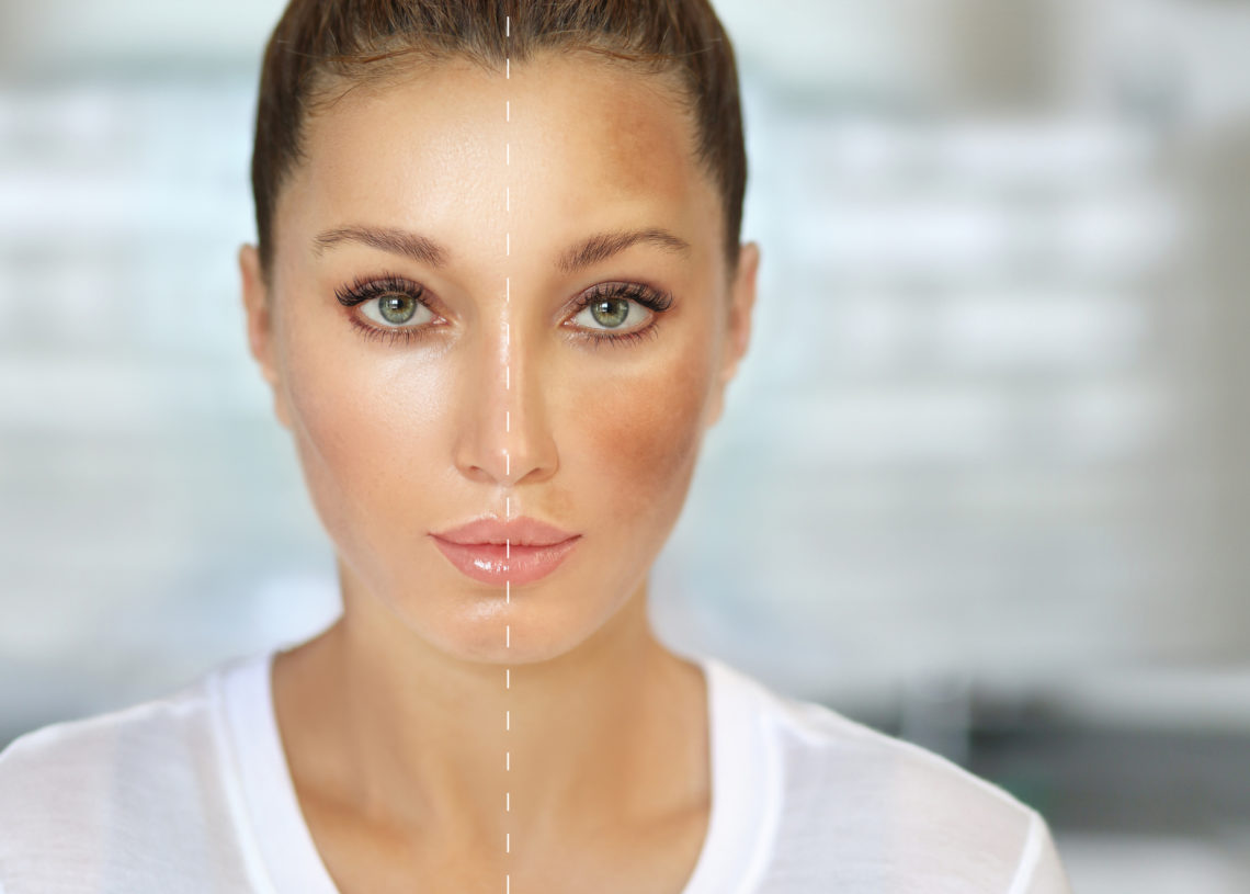 Dark spots, freckles,hyperpigmentation(melasma or chloasma)